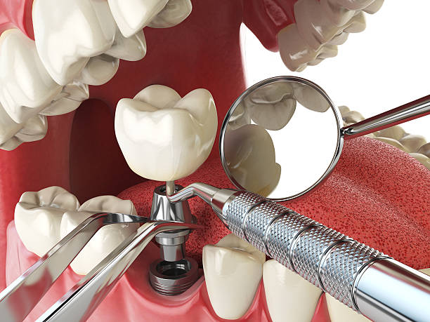 Best Emergency Tooth Extraction in Port Townsend, WA