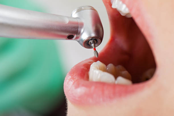Best Urgent Care for Lost Fillings or Crowns in Port Townsend, WA